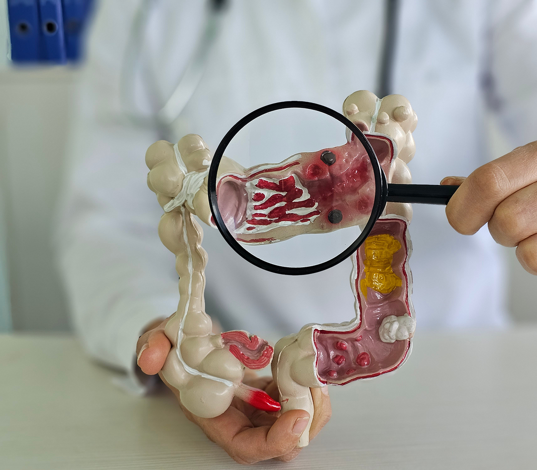 A person in a white coat holds a colon model, using a magnifying glass to show red inflamed areas that suggest intestinal disease.