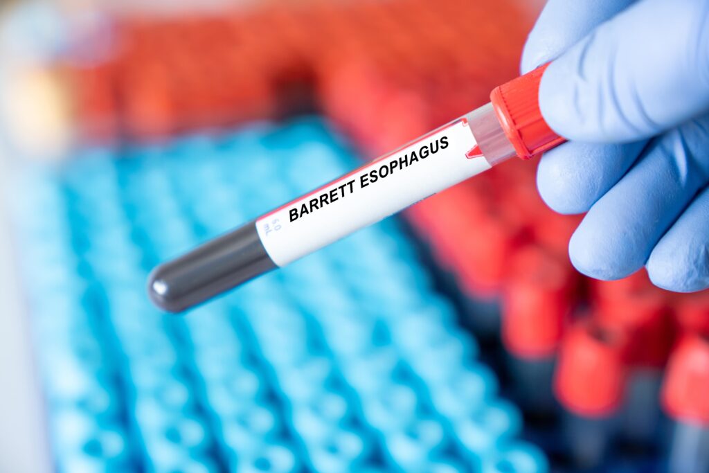 A gloved hand holds a blood sample tube labeled Barrett Esophagus with a red cap; blurred rows of test tubes are in the background.